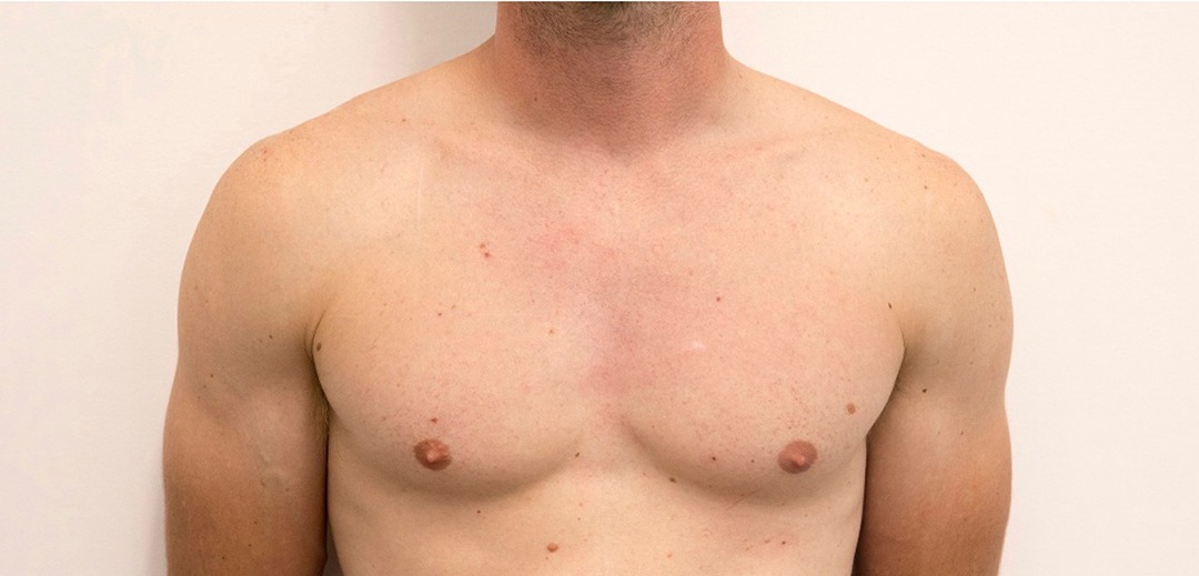 Laser Hair Removal Chest After