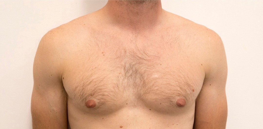 Laser Hair Removal Chest Before