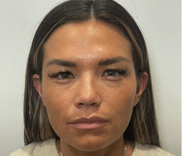 post wrinkle relaxers