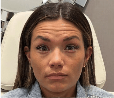 pre wrinkle relaxers